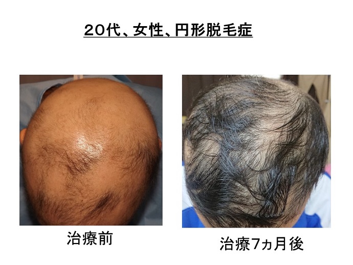 円形脱毛症　病院